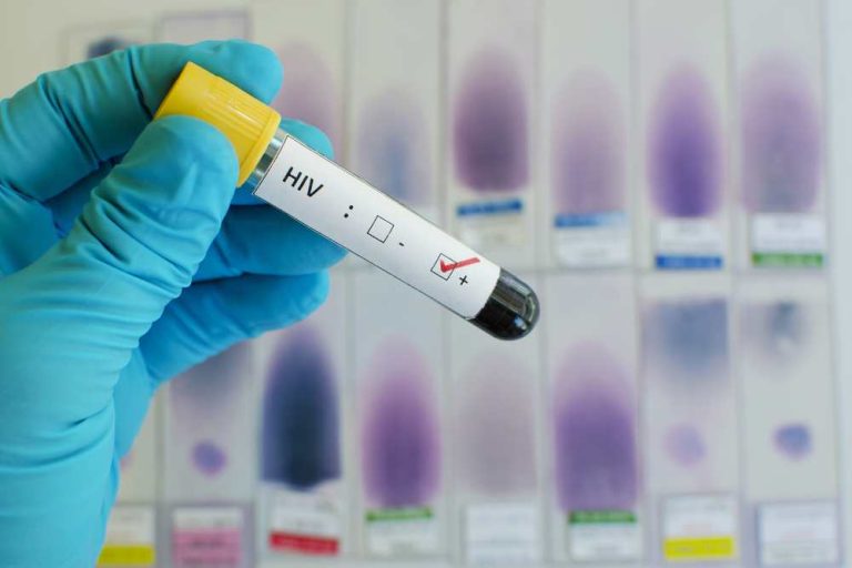 7 Early Symptoms of HIV Aids