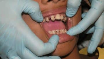 What is Considered a Dental Emergency Case?