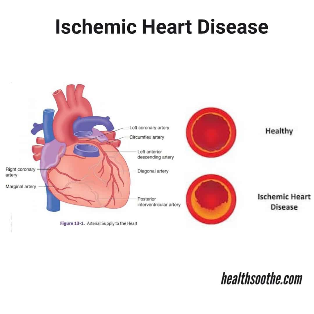 Pathophysiology Of Ischemic Heart Disease