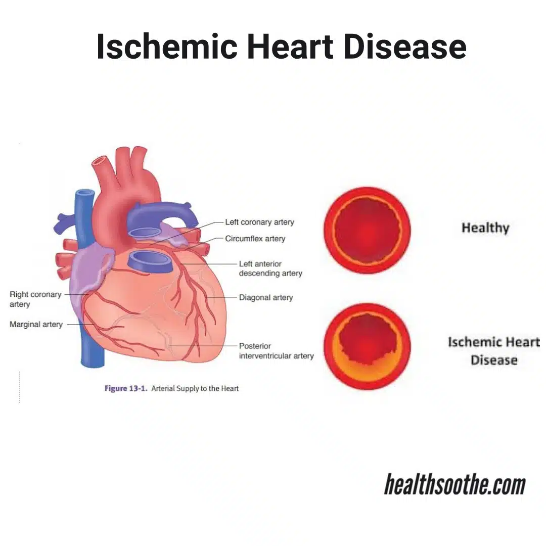 presentation of ischemic heart disease