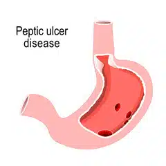 Pelptic ulcer