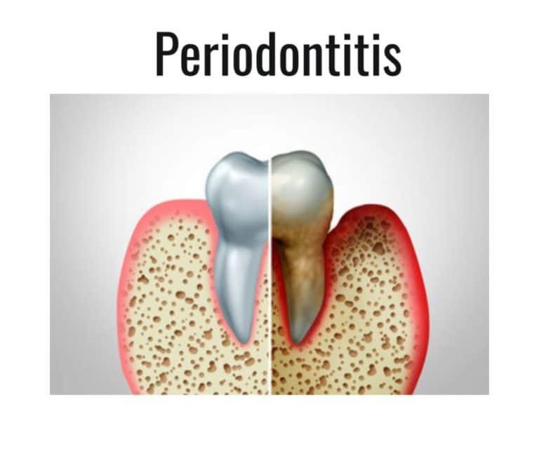 gingivitis or periodontitis picture