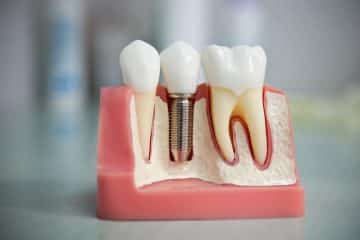 Dental Implants and Prostheses Analysis