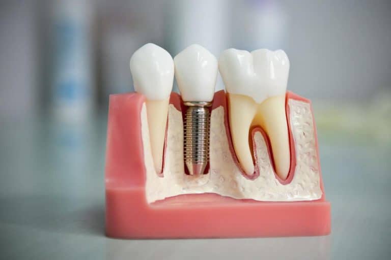 3 Reasons Why You Shouldn't Panic Before and After Implant Surgery