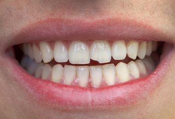 Dental Problems that Should Never Go Untreated