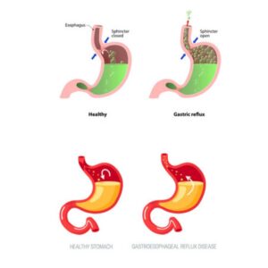 Importance Of Resolving Chronic Indigestion Issues To Avoid Acid Reflux