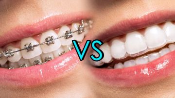 Find Out Which Is Better - Invisalign Or Braces