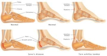 How to Recover from Achilles Tendon Injury with Braces