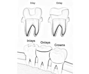 ABOUT DENTAL INLAYS AND ONLAYS: RESTORE DAMAGED TEETH