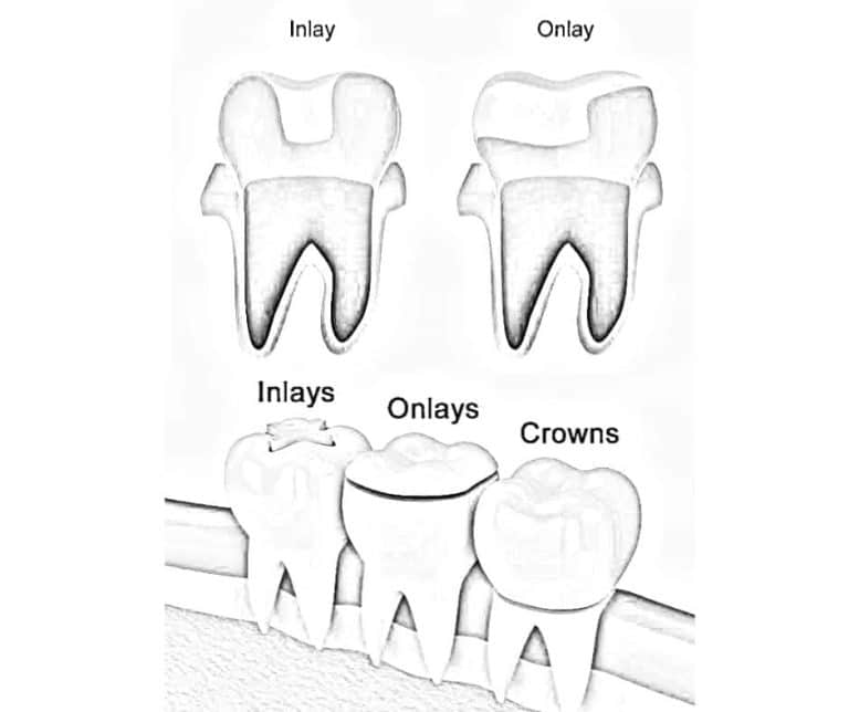 ABOUT DENTAL INLAYS AND ONLAYS: RESTORE DAMAGED TEETH