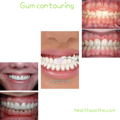 GUM CONTOURING: BEST CANDIDATES, TREATMENTS, AND INSURANCE 2 Gum contouring
