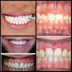 GUM CONTOURING: BEST CANDIDATES, TREATMENTS, AND INSURANCE