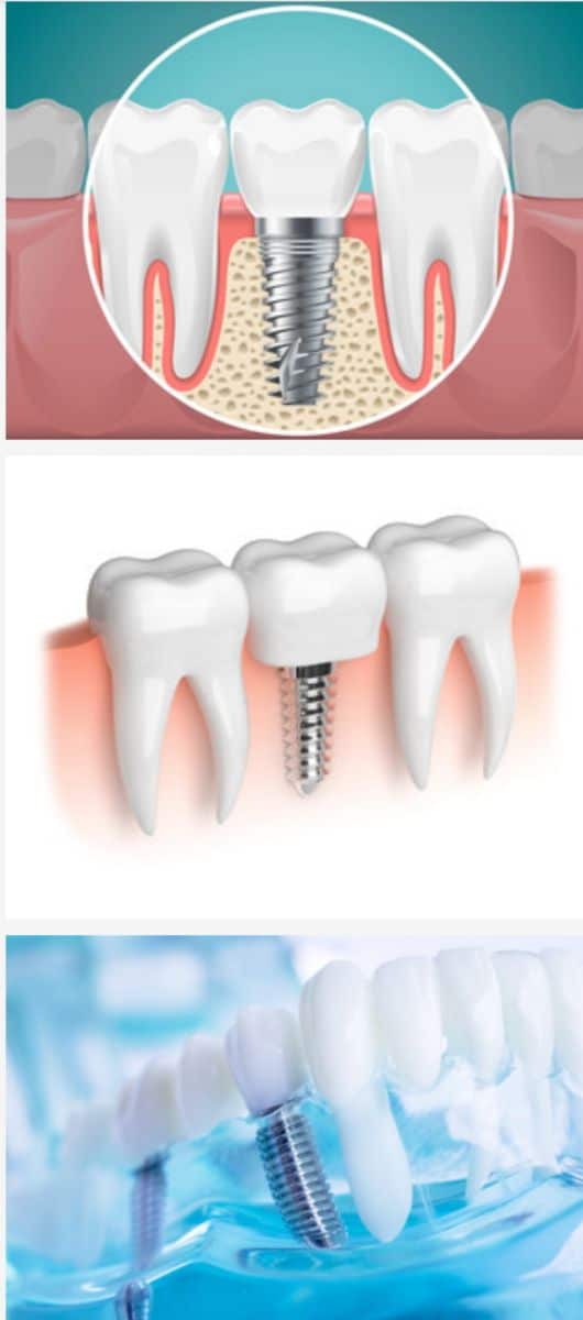 How Long Do Dental Implants Last?