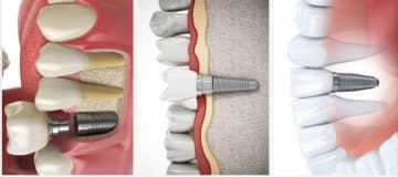 How Long Do Dental Implants Last?