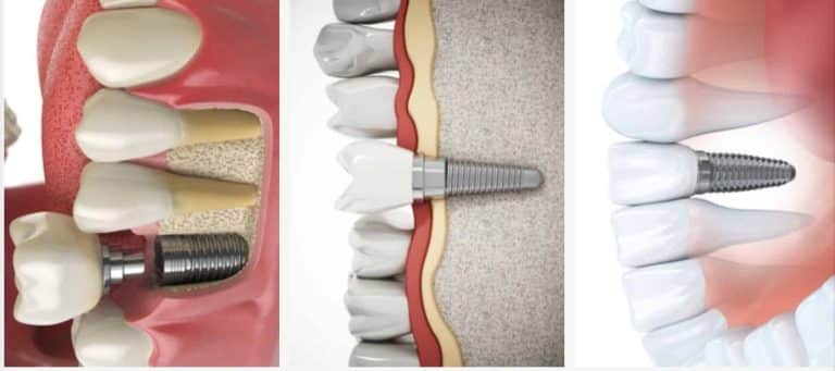 How Long Do Dental Implants Last?