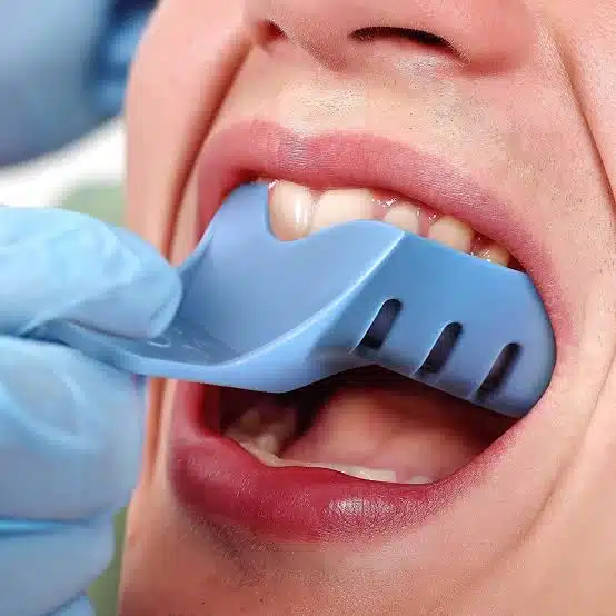 Impression Trays and Their Uses