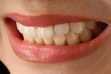 How To Take Care of Veneers and Everything Else You Need to Know