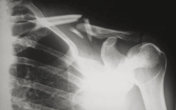 The Solutions To Your Hurting Shoulder