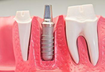 Dental Implants Used for More Than Cosmetic Dentistry