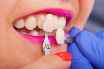 Porcelain Veneers Melbourne