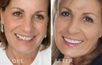 How Porcelain Veneers Melbourne Can Change Your Life?