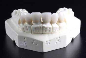 Important Things to Know About Dental Crowns
