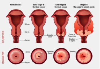 Cost Of Pap Smear-2