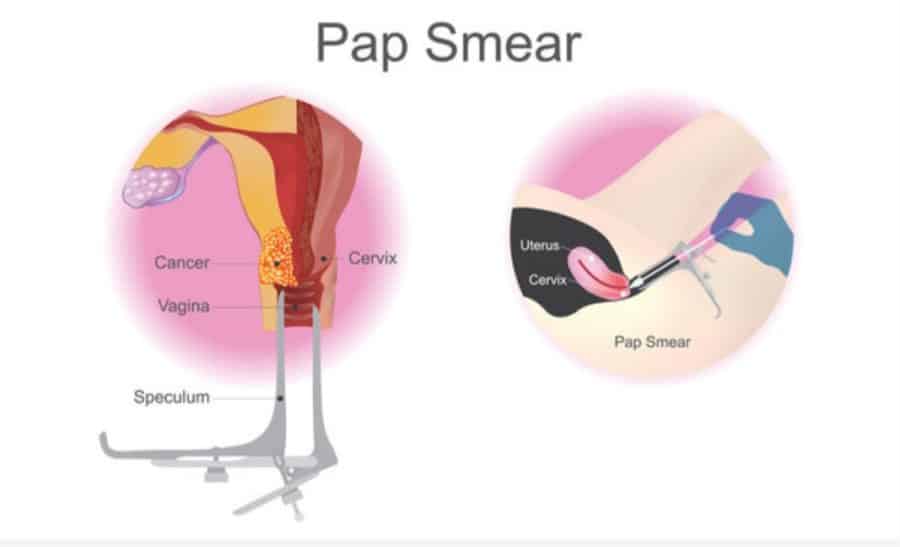 Cost Of Pap Smear In Nigeria Today: All You Need To Know