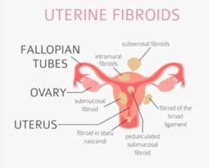 Cost Of Laparoscopy In Nigeria