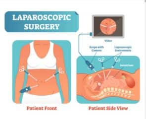 Cost Of Laparoscopy In Nigeria