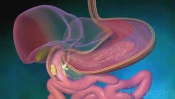 Nigerian foods for ulcer patients