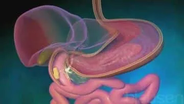 Nigerian foods for ulcer patients