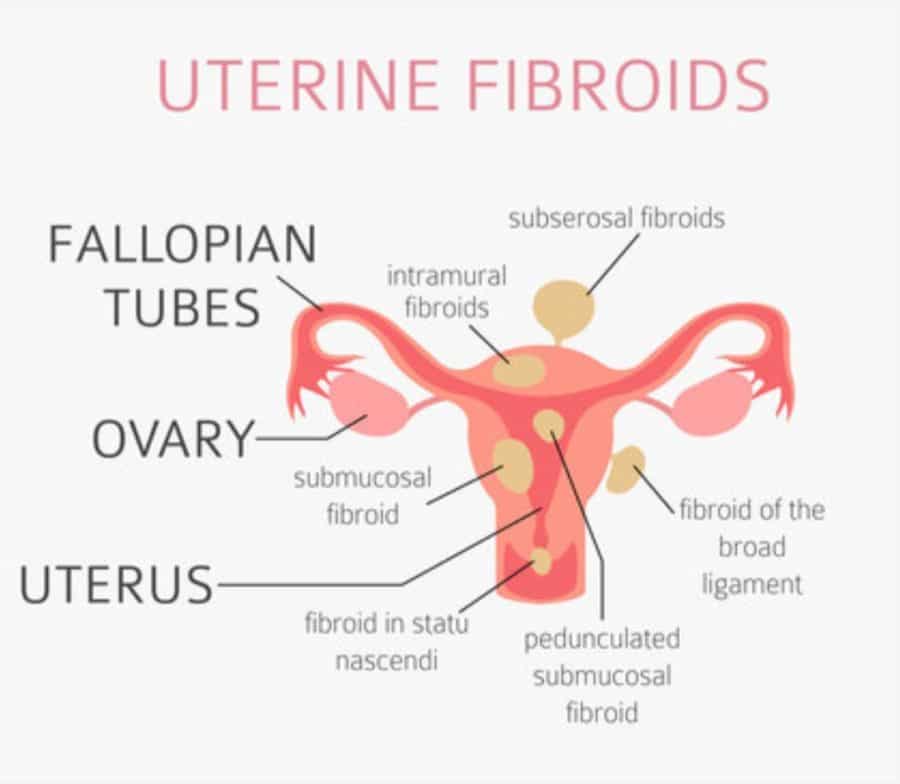 Cost Of Fibroid Surgery In Nigeria : All You Need To Know