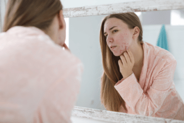 5 At-Home Acne Remedies to Try Today