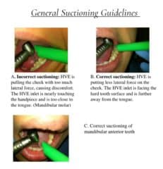How to properly use a dental suction