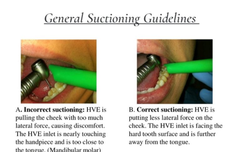 How to properly use a dental suction