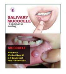 Mucocele: Causes, Symptoms & 5 Natural Treatments