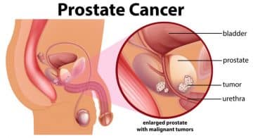 Prostate-Cancer.jpg