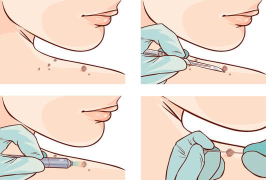 8 Ways to Get Rid of Pesky Skin Tags