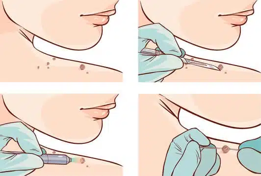 8 Ways to Get Rid of Pesky Skin Tags