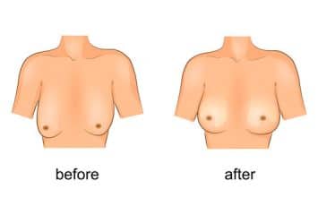 Breast lift – an alternative to breast implant