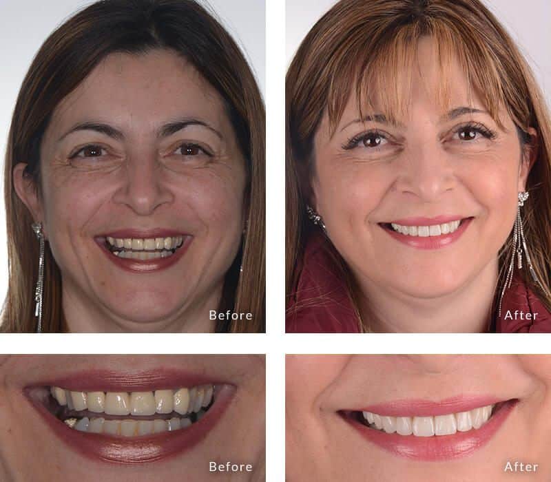 Cosmetic Dentist in Melbourne Reveals Popular Procedures for Improper Teeth