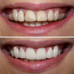 Affordable Porcelain Veneers