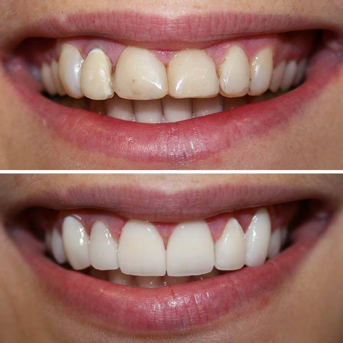 How Do Porcelain Veneers  Work 