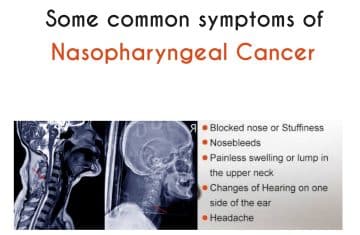 Nasopharyngeal Cancer