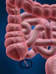 Appendix Surgery Cost in Nigeria
