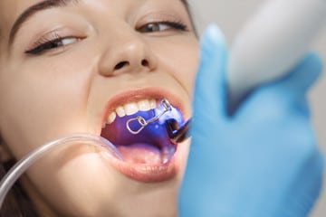 Is Dental Bonding Permanent?