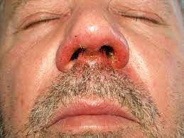 How To Treat Alefo In Babies Effectively Impetigo Affecting Adult