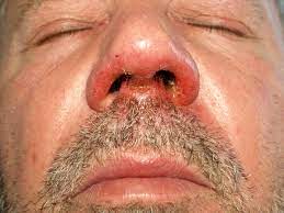 Impetigo Affecting Adult