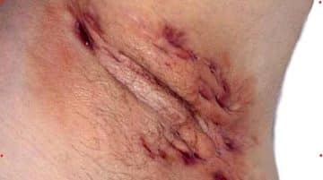 Pimple-like bump ob clitoral hood (causes)